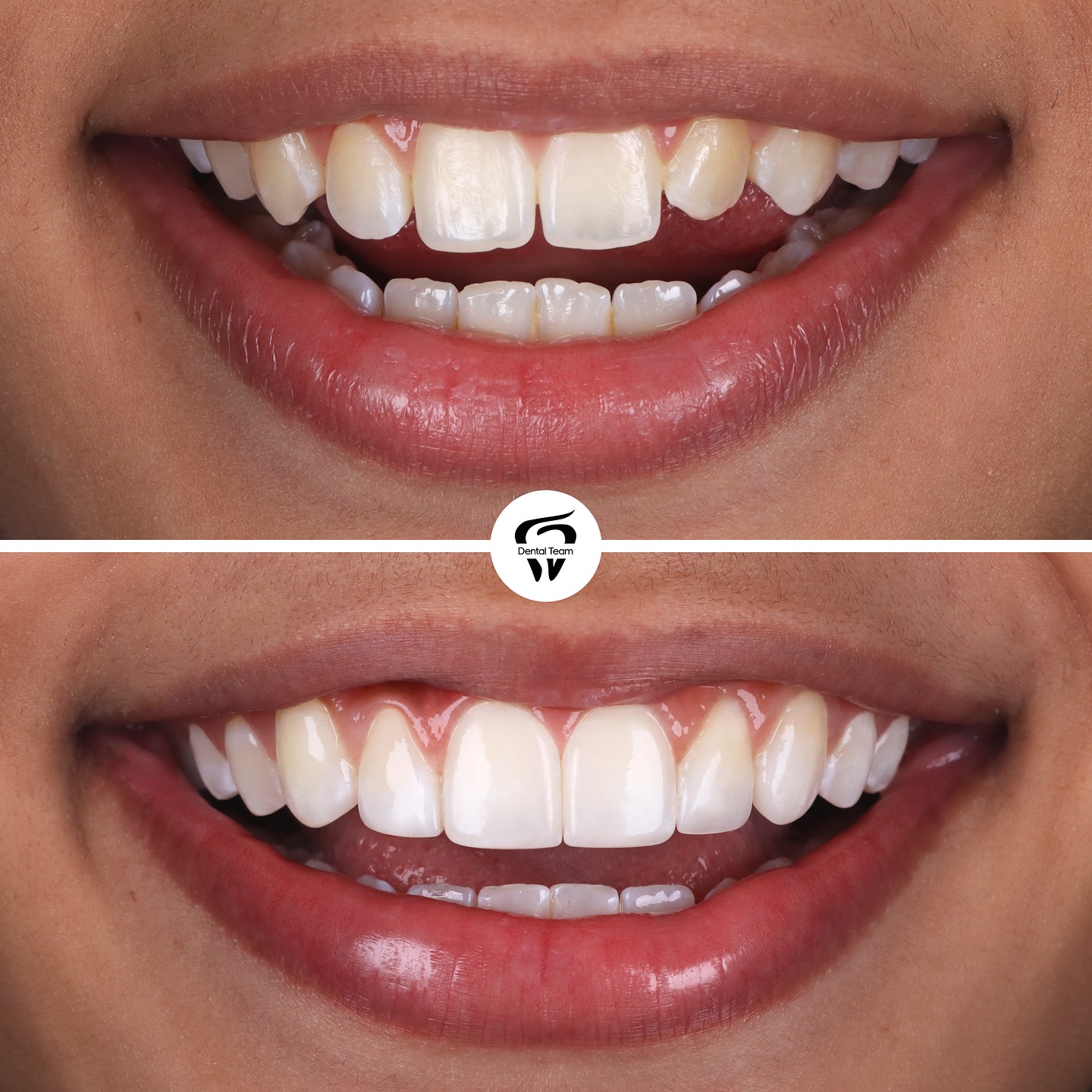 Caso de microdiseño de sonrisa 1