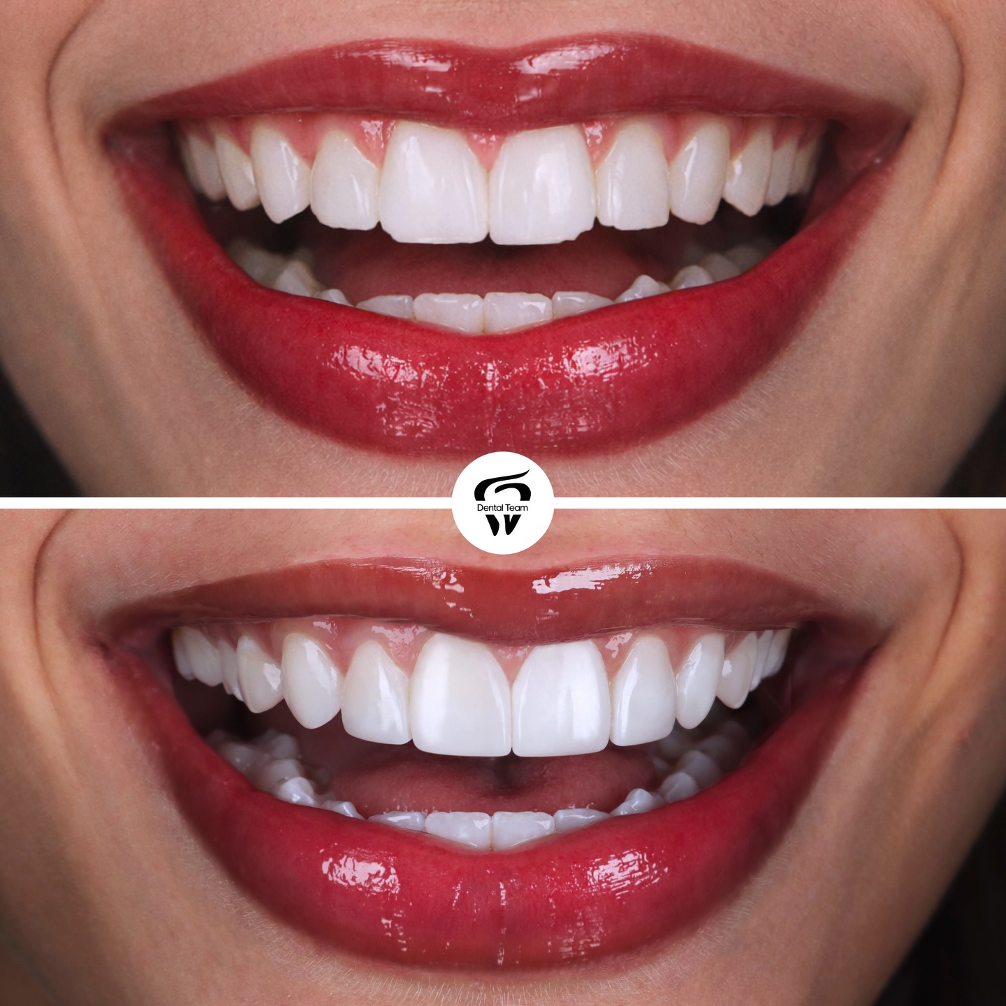 Caso de microdiseño de sonrisa 2